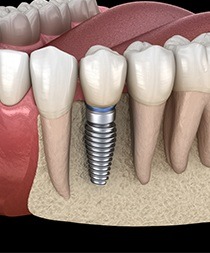 A 3D illustration of a single dental implant