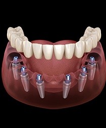 A 3D illustration of All-on-4 implants