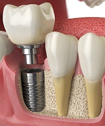 Diagram showing how dental implants in Gilbert fuse with bone