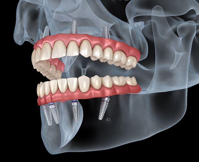 Illustration of All-on-4 dental implants in upper and lower arches