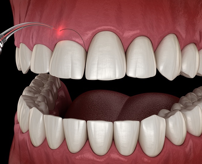 Animated smile during gum recontouring treatment