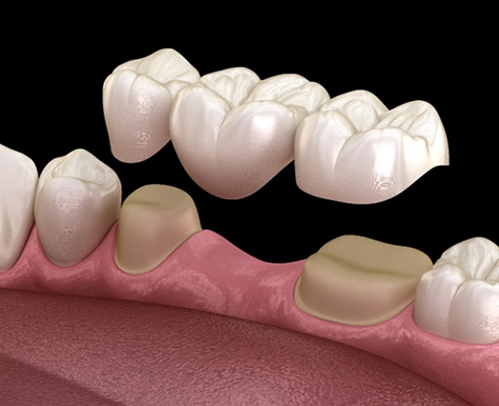 Digital illustration of dental bridge in Gilbert