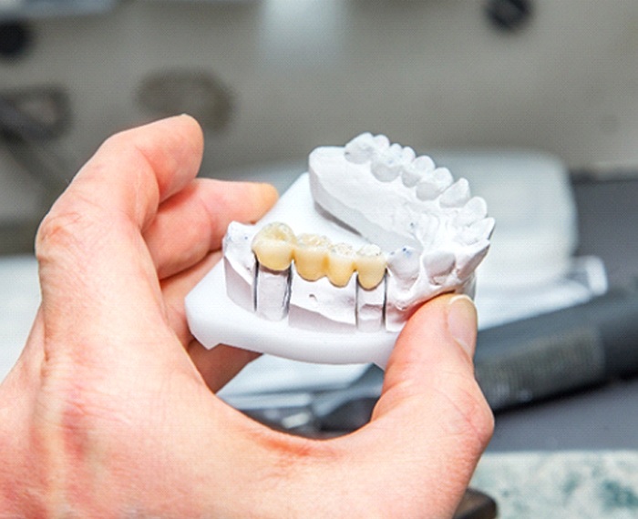 Dental bridge in Gilbert on clay model