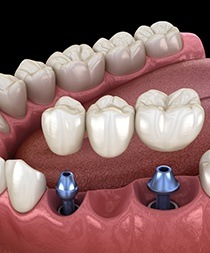 A 3D illustration of an implant bridge