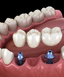 Animated dental implant supported fixed bridge