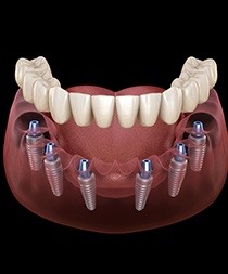 Animated dental implant supported denture