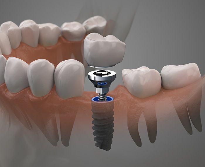 Animated dental implant supported replacement tooth components