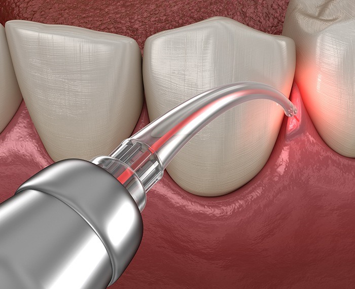 Animated smile during laser periodontal therapy