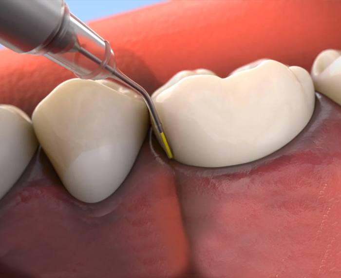 Animated smile during Arestin antibiotic therapy