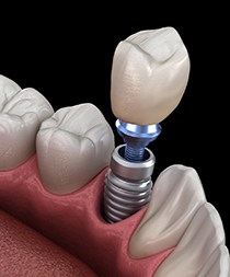 An up-close look at a digital image that contains a single tooth dental implant and all its parts