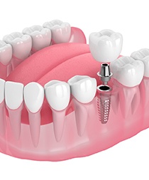 A digital image of a customized dental crown sitting on top of a metal abutment and dental implant