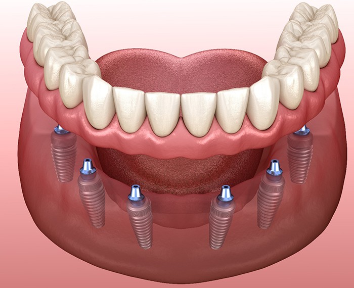 Implant dentures in Gilbert