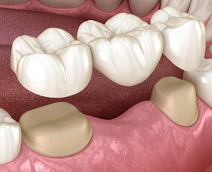 Animated dental bridge placement