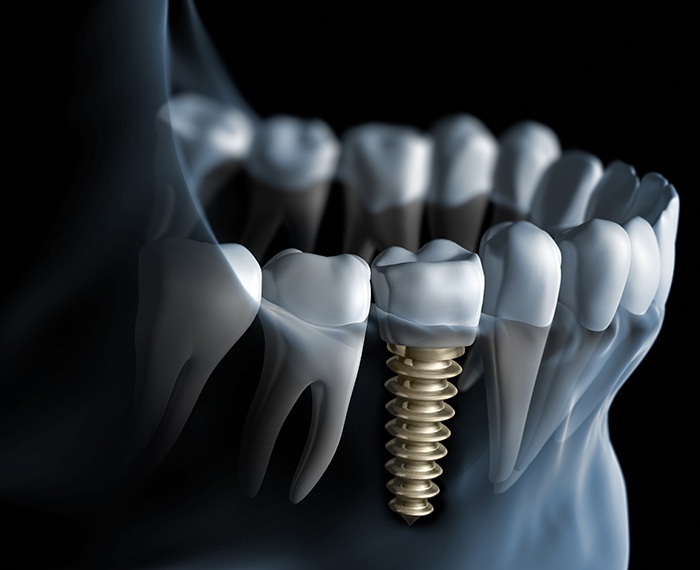 Animated dental implant supported dental crown