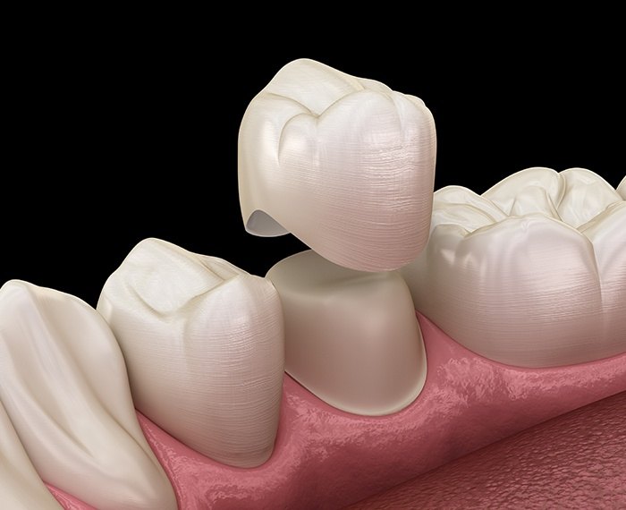 Animated dental crown placement