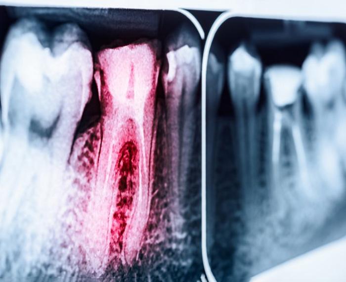 an X ray of a tooth requiring root canal treatment