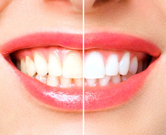 Patients smile before and after teeth whitening in Gilbert