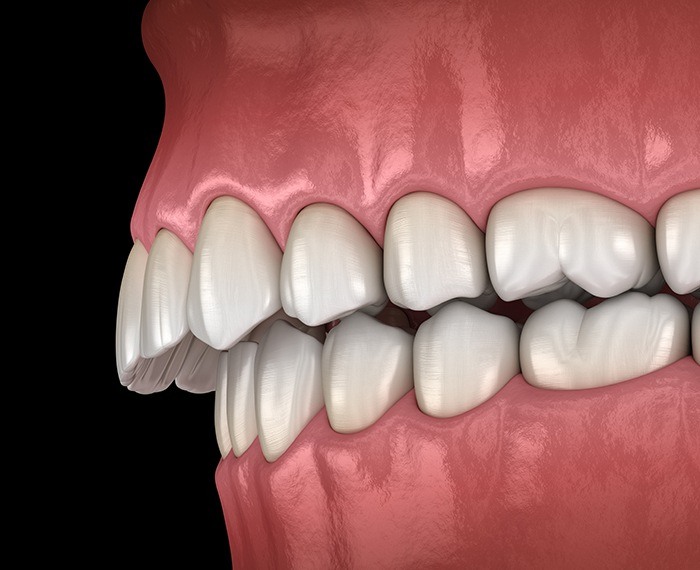 Animated bite in need of occlusal adjustment