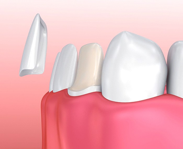illustration of a veneer being placed onto a tooth