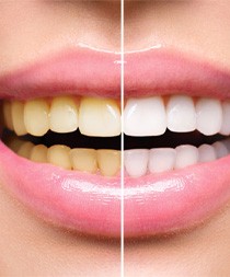 Before and after teeth whitening