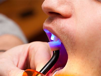 a closeup of a patient receiving dental bonding in Gilbert, AZ