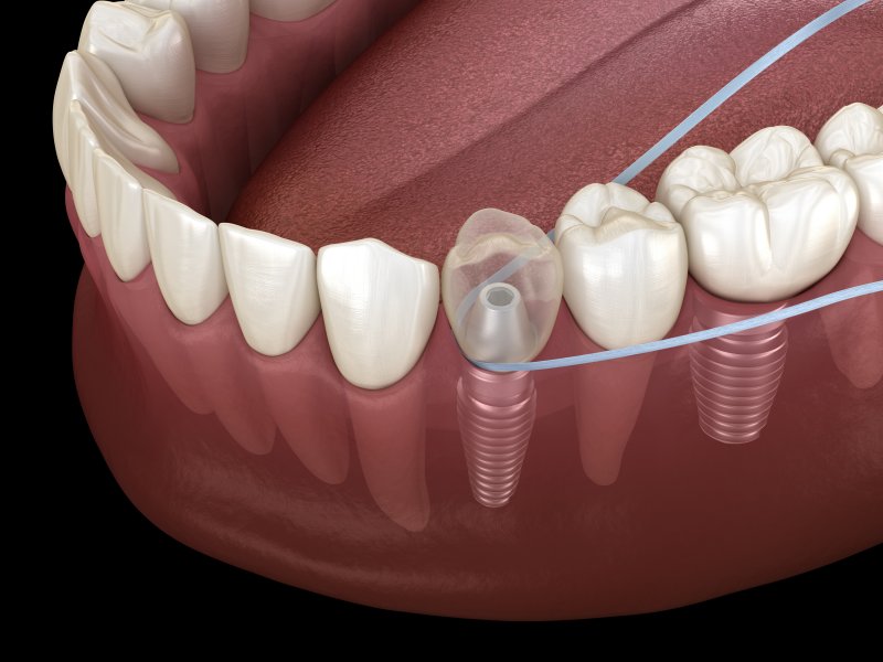 3-D diagram of a dental implants being flossed