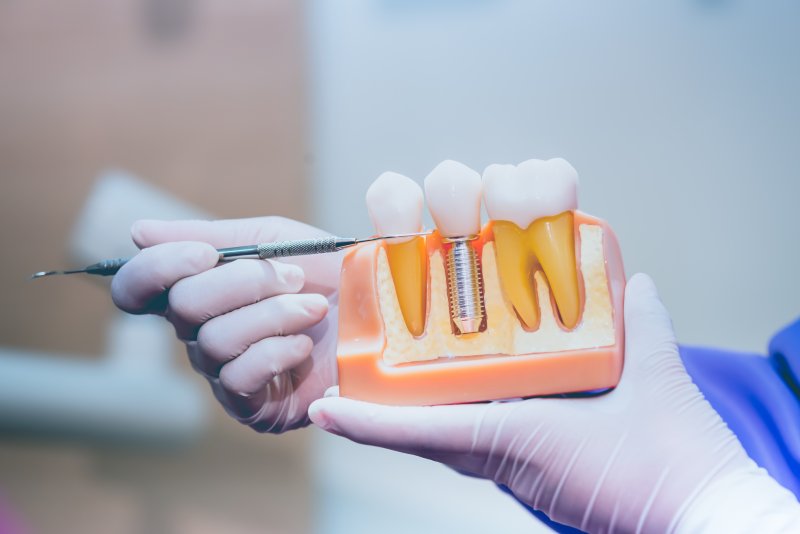 A hand holding a model of dental implants
