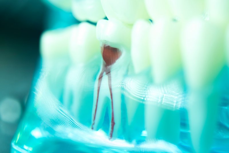 An X-ray of the pulp chamber of a tooth that needs a root canal