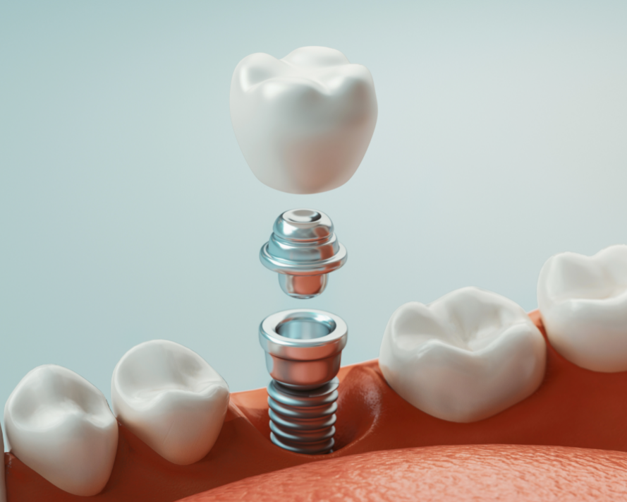 3D image of a dental implant