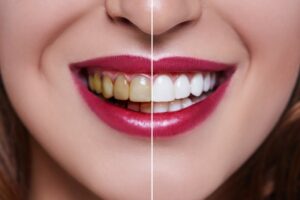 Side-by-side comparison and before and after teeth whitening. 
