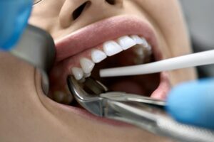 Tooth extraction being performed.