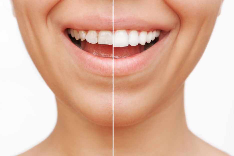 A woman’s smile before and after getting veneers.